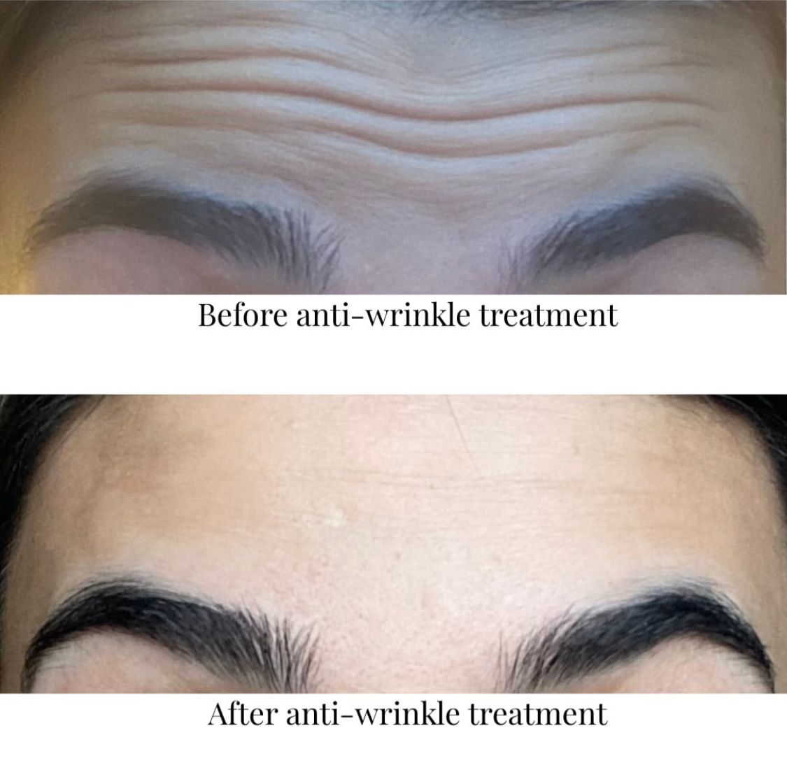 Forehead before and after lines and wrinkles treatment