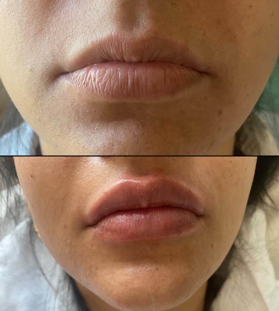 Before and after lip enhancement result