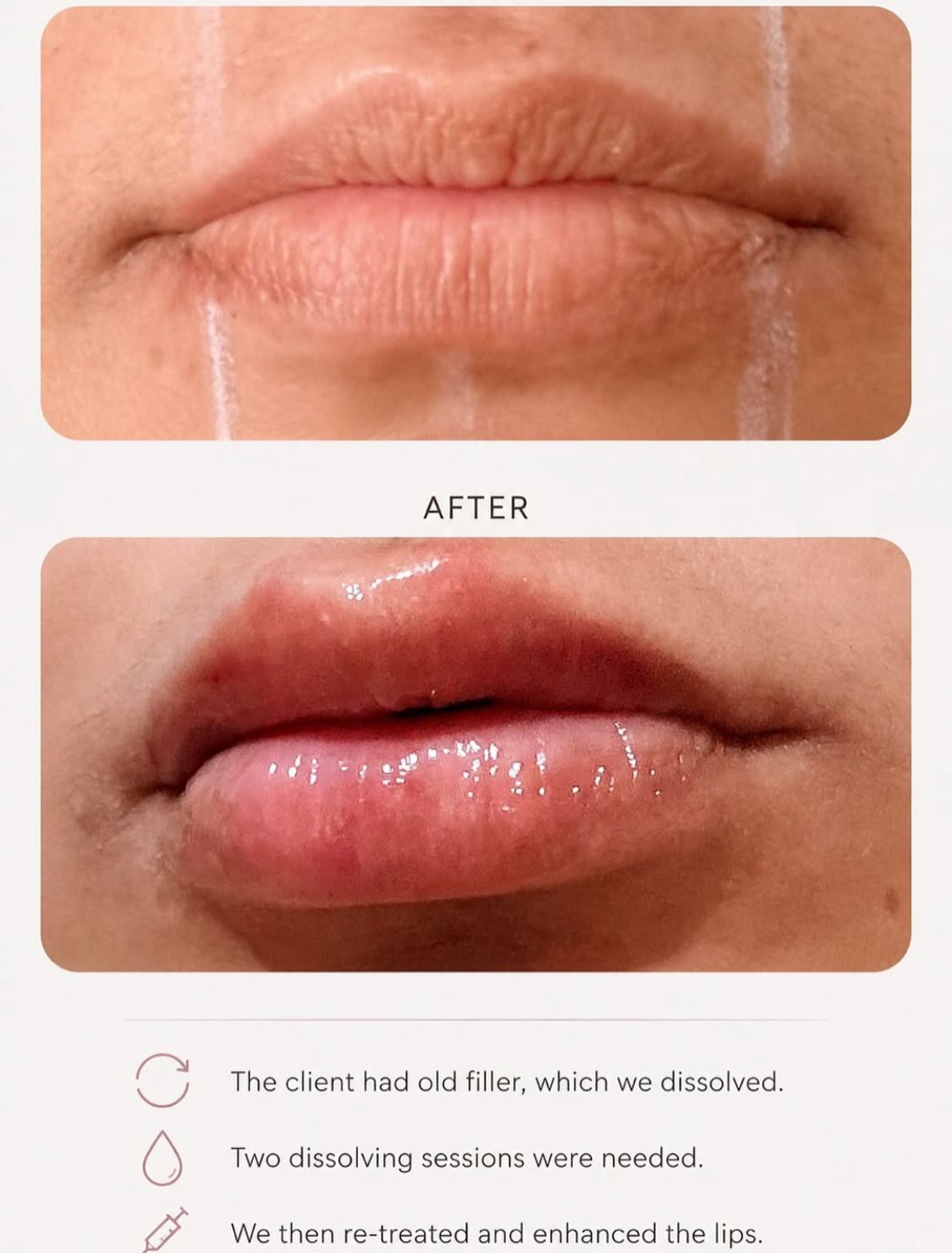 Before and after lip filler correction and enhancement result